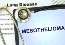 Types of Mesothelioma – You Must know