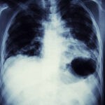 life threatning lung cancer