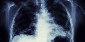 Life Threatening Lung Cancer