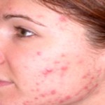 common causes of acne