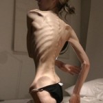 ill effects of anorexia