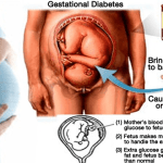 gestational-diabetes